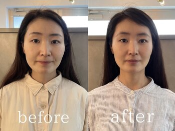 カミベヤ(KAMIBEYA)の写真/《骨格補正スパ技術》大人のための左右バランスケア。髪を育む土台を作るヒト幹細胞培養液導入ケアやEMSも