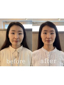 《骨格補正スパ技術》大人のための左右バランスケア*髪を育む土台を作るヒト幹細胞培養液導入ケアやEMSも◎