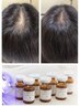 【頭皮から活髪】ヒト幹細胞培養液・強髪program　