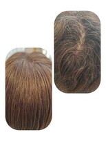 ユーフォルムギンザ(y-Forme Ginza)&nbsp;話題のトキカタ♪頭頂部編