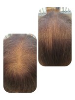 ユーフォルムギンザ(y-Forme Ginza)&nbsp;話題のトキカタ♪頭頂部編