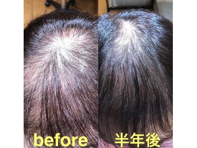 幹細胞培養液を使用した強髪スパ、予防美容・頭皮改善にオススメ