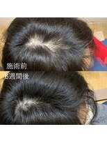 ジェントラ(Jentra)&nbsp;育毛効果実感コース