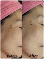 グラスヒビキ レディースシェービングエステ:悩み【くすみ、乾燥】