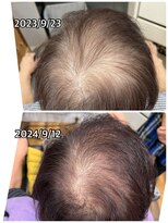 エミ(EMI)&nbsp;育毛促進