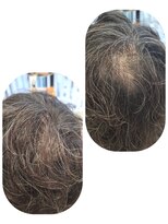 ユーフォルムギンザ(y-Forme Ginza)&nbsp;話題のトキカタ♪頭頂部編