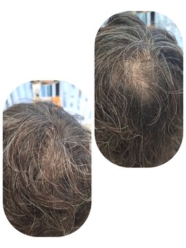 ユーフォルムギンザ(y-Forme Ginza) 話題のトキカタ♪頭頂部編