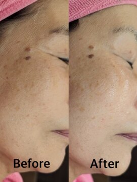 グラスヒビキ レディースシェービングエステ：悩み【くすみ、小ジワ】