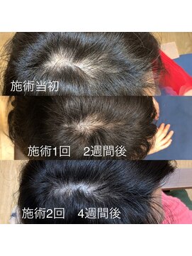 ジェントラ(Jentra) 育毛促進実感コース