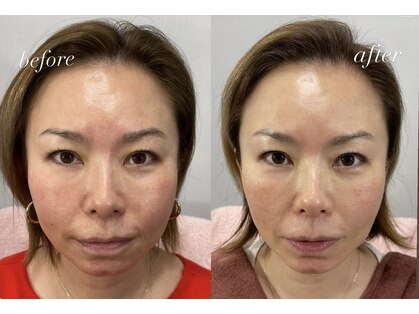 毛染め専門店 からの 生エクソソームサロンの写真