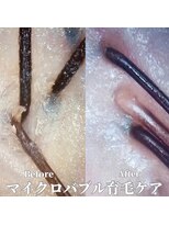 ヘア プレゴ 東陽町店(hair Prego) マイクロバブル育毛促進ケアBefore&After