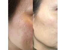 サーカス 銘苅店(circus)の雰囲気（幹細胞上清液を使用した肌質改善も多くのお客様から人気です♪）