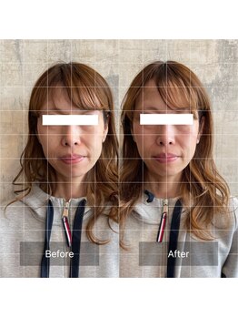 フフラ KANコルギセラピー山梨本店(fufla)/【小顔ソムリエ】頭蓋骨小顔矯正