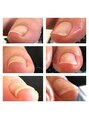 ネイルサロン ヴィクシア(Nail Salon VIXIA) 巻爪でお悩みの方もご相談ください。