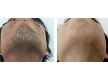 エミエット(Emiette)/男性ひげ脱毛