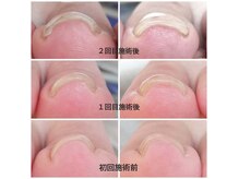 ミコ(.mico)の雰囲気（塗るだけ！巻き爪が改善する特殊ジェル。カラーも出来ます。）