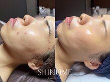 シノノメ(SHINONOME)の雰囲気（【効果実感】結果重視の実力派サロン【肌質改善◎】）