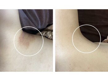 サロンデュ ひゃーく(Salon du ひゃーく)/～脇も人幹細胞で綺麗に！～