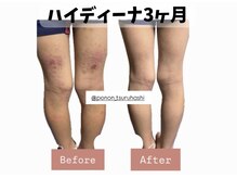 ヨサパーク ポノン(YOSA PARK ponon)/【Before→After】水素酸素ケア