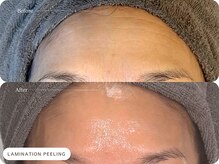 キュレイテッドスキン(CURATED SKIN)/30代.ニキビケア4回目 After