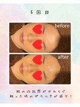 リリアン(lirien)/毛穴/毛穴ケア/毛穴洗浄/駒込