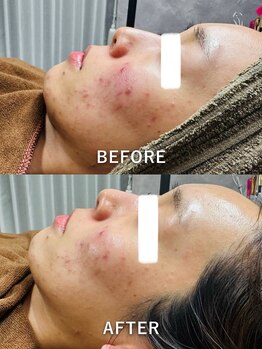 ルーク(Luke)/ニキビケア／くすみ／毛穴