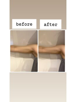 リズ(Liz)/20代女性 二の腕の施術