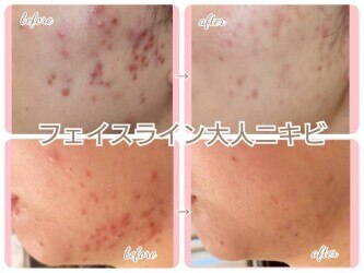 8ページ目｜ハーブピーリング 剥離ありに関するエステサロン ハーブ