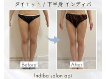 アピ(api)/症例写真【痩身インディバ】