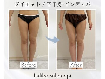 アピ(api)/症例写真【痩身インディバ】
