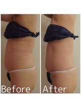 トータルビューティサロン クイーン(Queen)/お腹周りや腰回りの贅肉除去！