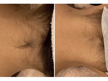 ヴィアス(vias)/うなじ脱毛