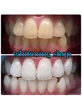 ホワイトニングショップ 豊橋店(WHITENING SHOP)/Before&After豊橋ホワイトニング