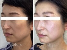 ブルースター/横顔の印象変化（40代）