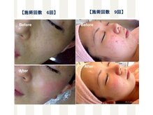 エム(M)の雰囲気（厳選国産ハーブピーリングで肌荒れニキビケア、シミシワケア）