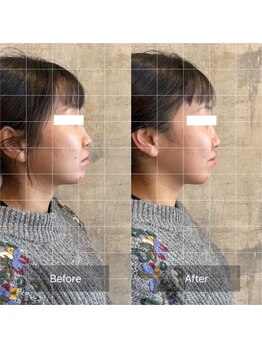 フフラ KANコルギセラピー山梨本店(fufla)/【小顔ソムリエ】頭蓋骨小顔矯正