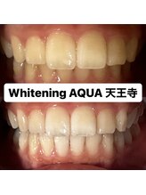 アクア 天王寺店(AQUA)/セルフホワイトニング/天王寺