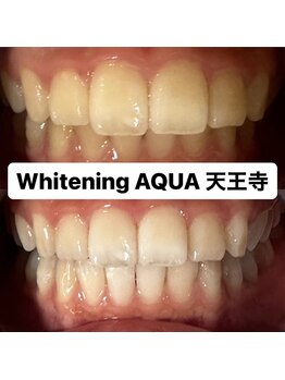 アクア 天王寺店(AQUA)/セルフホワイトニング/天王寺