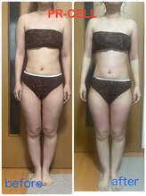 スーコ(SU:CO)/セル撃退！PR.CELL 施術一回