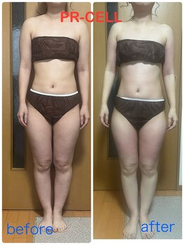 スーコ(SU:CO)/セル撃退！PR.CELL 施術一回