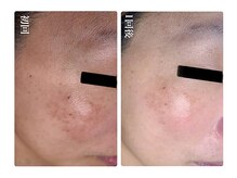 キレイ(KIREI)/初回→1回後