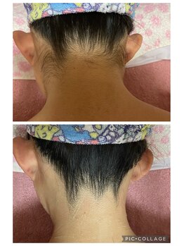 スウィートボディ(Sweetbody)/★えり足の脱毛★