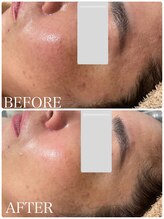 イリゼ(IRISER)/日本初上陸のピーリング