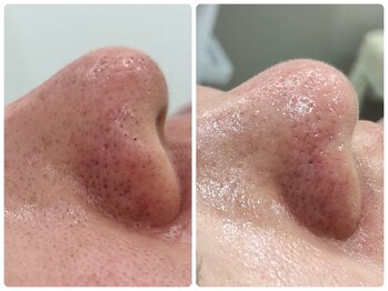 ベルネ(BELLUNE)/ベルネ式毛穴洗浄