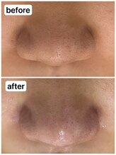 アール(R)/【 毛穴洗浄+ジェリーマスク 】