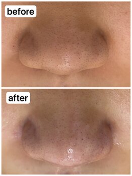 アール(R)/【 毛穴洗浄+ジェリーマスク 】