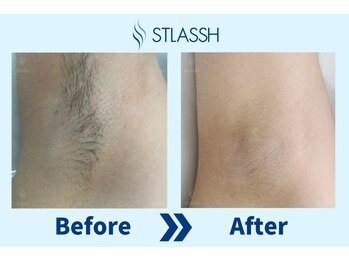 ストラッシュ 武蔵小杉店(STLASSH)/【ストラッシュ】お客様の施術例