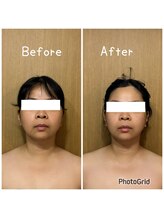 ハニー(Honey82)/小顔姿勢コルギ　比較写真