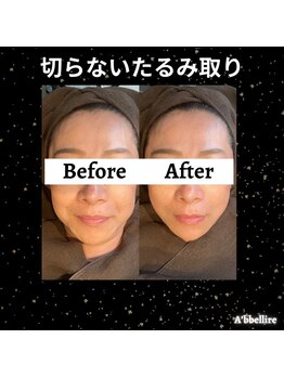 アッヴェリーレ(A'bbellire)/小顔にはリフェイス☆