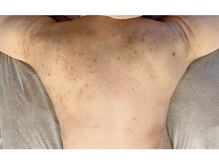 モネ(monet)/跡、色ムラにお悩みの方